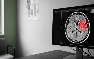 Why Stroke Awareness Matters at Any Age and What Happens When Diagnosis Is Delayed